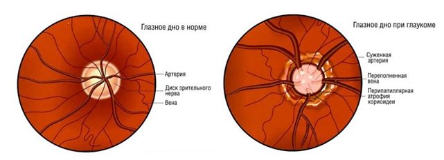 глазное дно.jpg глазное дно.jpg