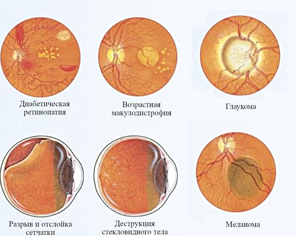 виды глазных заболеваний.jpg виды глазных заболеваний.jpg